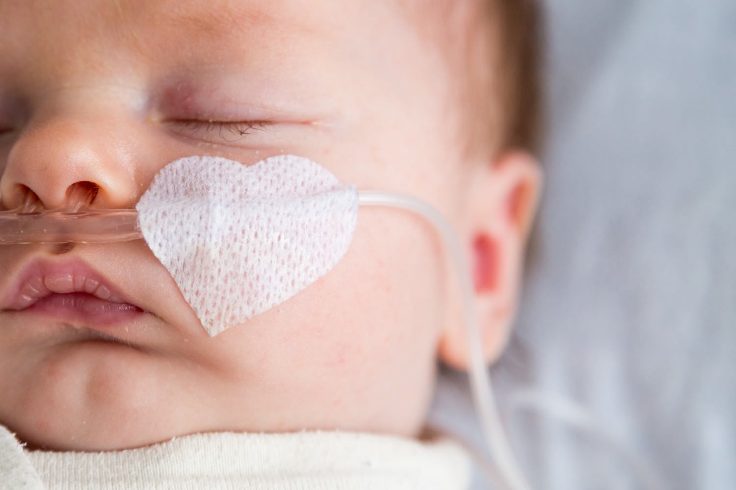 Bild zeigt: Neugeborenes mit Sauerstoffbrille